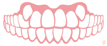 Inghesuire dentara