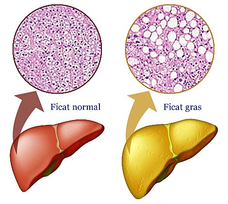 Steatoza hepatica - ficatul gras