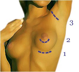 Tipuri de incizie pentru marirea de san prin implant mamar