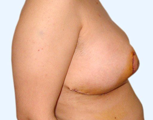 Micsorarea sanilor - reductie mamara
