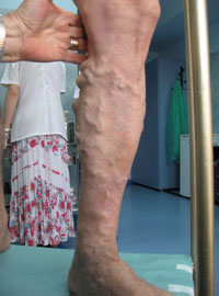 large varicose veins treatment - before